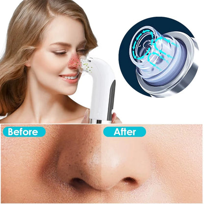 Electric Vacuum Blackhead Acne Pore Cleaner